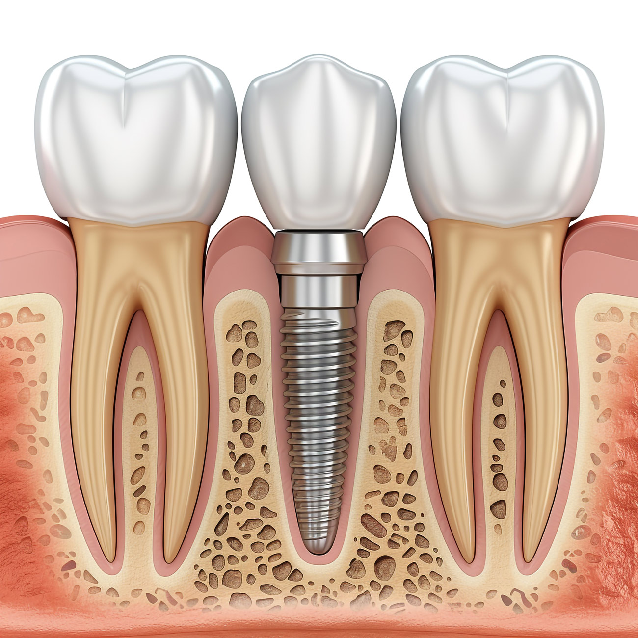 aktif dent implant AKTİF DENT www.aktifdent.com.tr info@spain.com.tr 05399280551